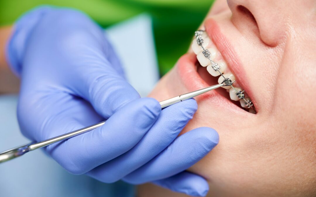 Maintaining Braces in Naples, FL: A Guide by Brace Place Naples and Dr. Albert