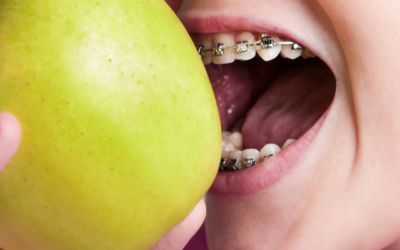 How Your Diet Affects Your Braces Journey